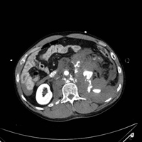 CT Scan